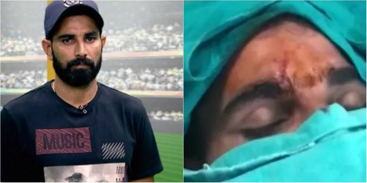 mohammed shami injured in road accident सड़क हादसे में मोहम्मद शमी को लगी गंभीर चोट, सिर में लगे 10 टांके